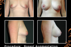 BreastAug-5761