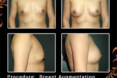 BreastAug-5913-2