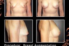 BreastAug-5981