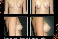 BreastAug-5998-2