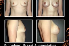 BreastAug-6107
