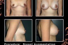 BreastAug-6123