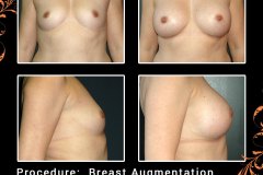 BreastAug-6210