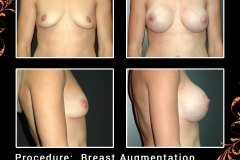 BreastAug-6223