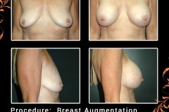 BreastAug-6287