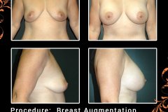 BreastAug-6302