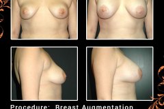 BreastAug-6306