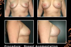 BreastAug-6456