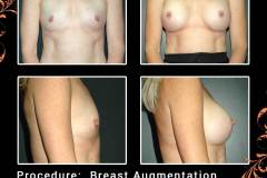 BreastAug-6463