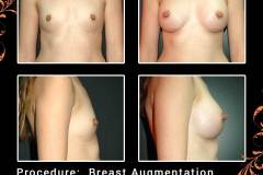 BreastAug-6504