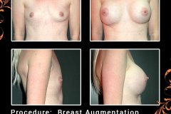 BreastAug-6563-c