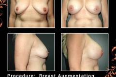 BreastAug-6568-b