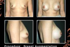 BreastAug-6571