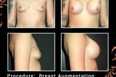 BreastAug-6596