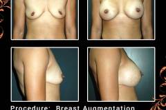 BreastAug-6628