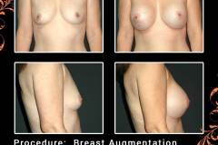 BreastAug-6641-b