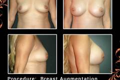 BreastAug-6742