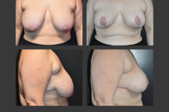 12_mastopexy