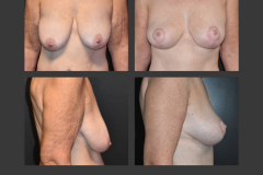17_mastopexy