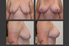 1_mastopexy