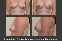 20_breast aug and mastoplexy