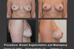 27_breast aug and mastopexy