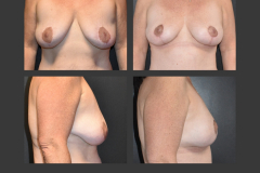 32_mastopexy