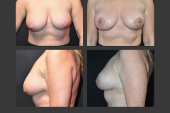 41_mastopexy