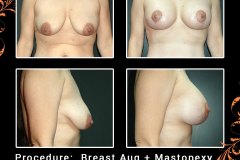BreastAug-6631
