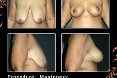 Mastopexy-6453