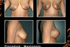 Mastopexy-6543