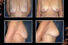 mastopexy-0272