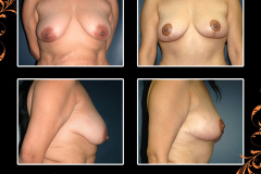 mastopexy-0329