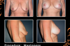 mastopexy-0331