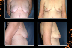 mastopexy-0405
