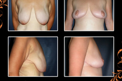 mastopexy-0453