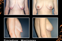 mastopexy-0518