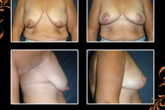 mastopexy-0713