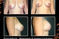 mastopexy-0827