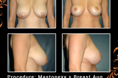 mastopexy-1098