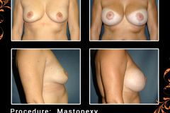 mastopexy-1171