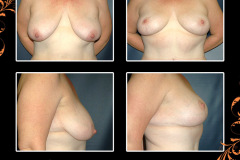 mastopexy-1308