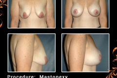 mastopexy-1728