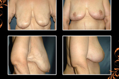mastopexy-2060