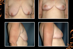 mastopexy-2218
