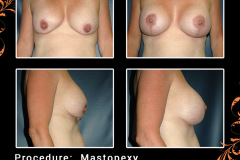 mastopexy-2241