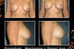 mastopexy-2405