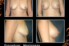 mastopexy-2424