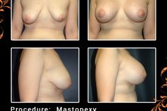 mastopexy-2703