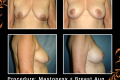 mastopexy-3223